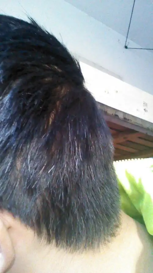 这少白头怎么治,缓解也行