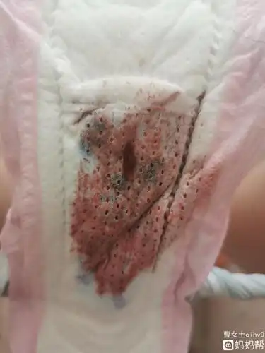 哪家好!移植停药后却又成功了"眉飞眼笑"-第2张图片-宝林网