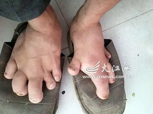 "大脚哥"终于穿上了合适的鞋