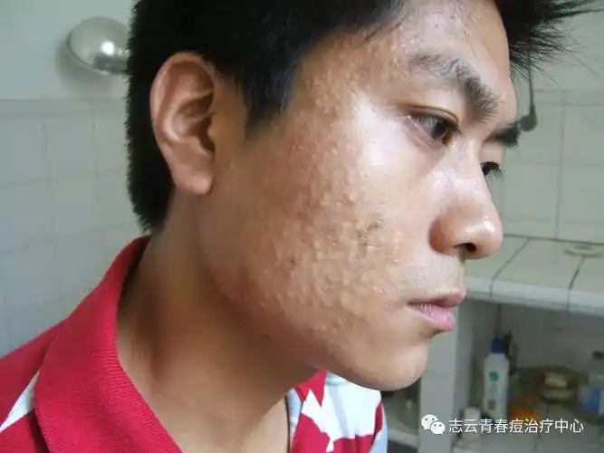 毛孔堵塞是引起脸上长痘痘的根源吗