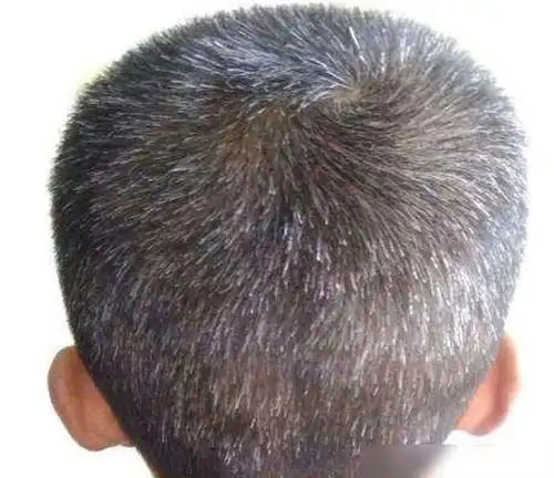 小孩有白头发是什么原因儿童长白头发的五种原因