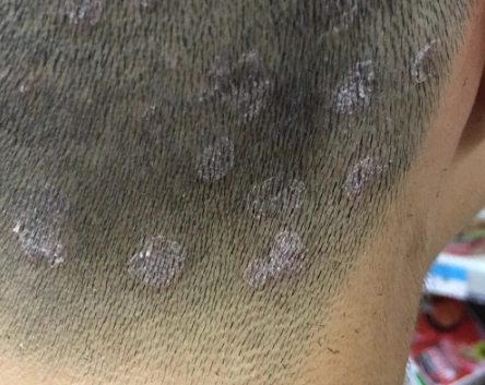 头癣的症状图片 (59)