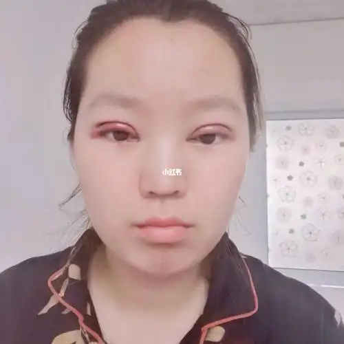 双眼皮手术第二天