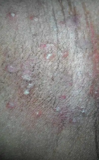 体癣初期图片 (33)