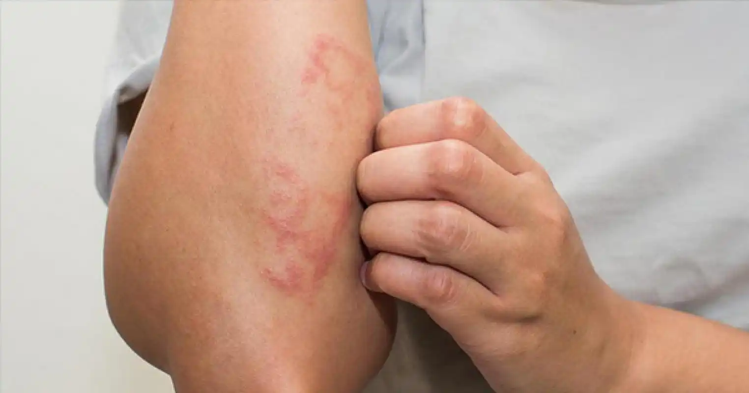 湿疹的忌口食物有哪些#   湿疹常见于皮肤病,症状包括皮肤发红,瘙痒