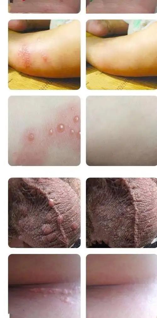 结节硫磺软膏阴虱螨虫疥虫阴囊瘙痒皮肤瘙痒止痒膏膏 【一疗程】买3