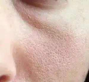 老化的毛孔粗大被清除几天后根除毛孔粗大要有耐心毛孔粗大也不例外众