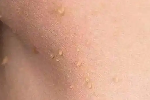 女性脖子上长丝状疣主要表现为颈部出现高于皮面的疣状增生物,常呈皮