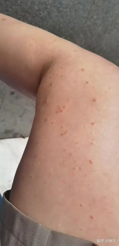 过敏性湿疹治疗过程