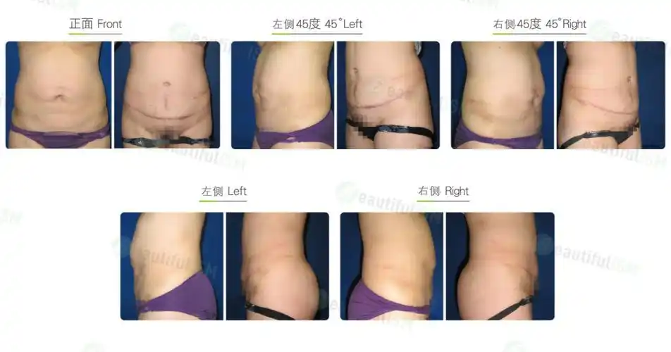 腹部拉皮-全腹拉皮 肚脐重整(女)效果图,案例前后对比照片