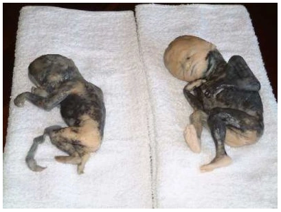 打胎真实照片触目惊心