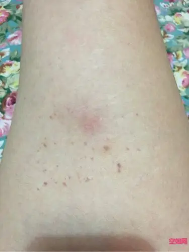 腿上被蚊子咬了,然后挠的有点淤血,5号就体检会不会有影响?