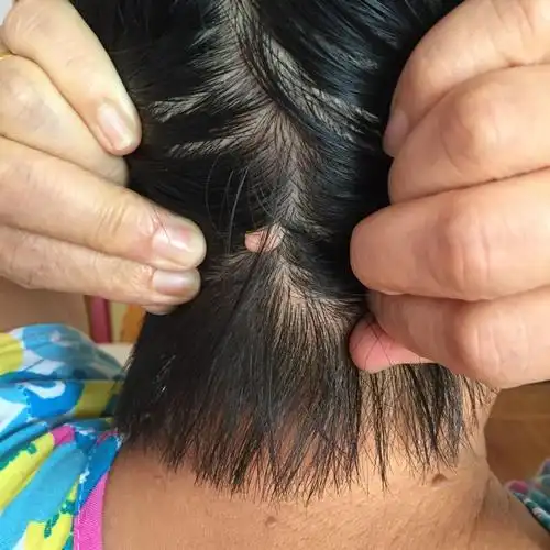家人头后面正中间长了一颗肉瘤还是痣一样的东西,以前没有,后来长的
