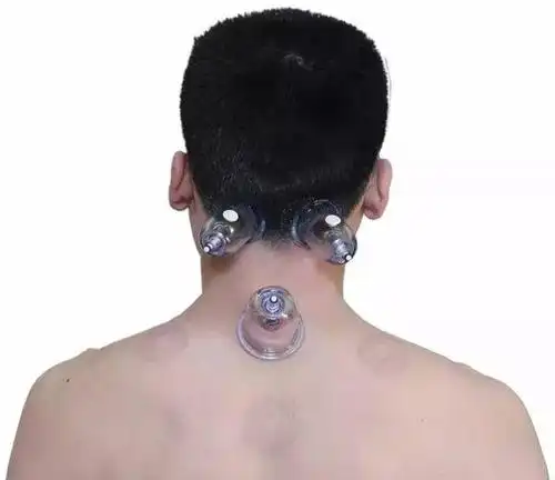 只需叩拔3个罐,轻松搞定"肩周炎"3天见效!