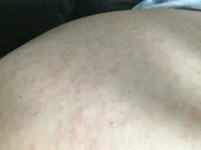 屁股上长很多疙瘩,很痒