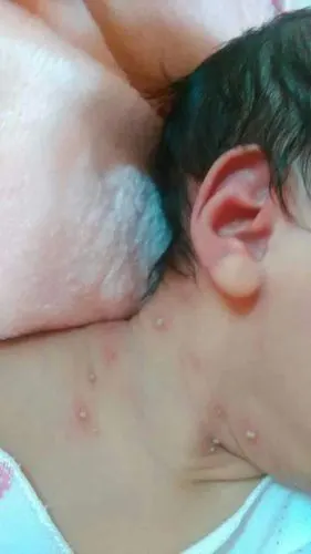 宝宝身上有小脓疱,该怎么治疗?急急急