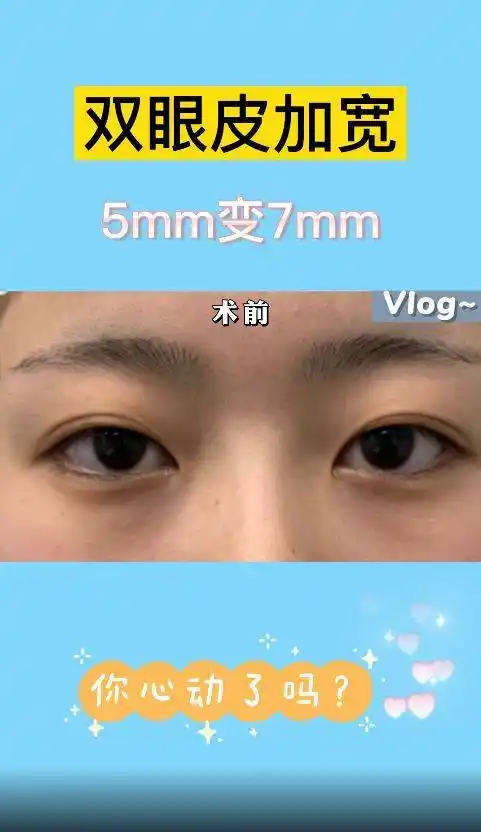 双眼皮修复,5mm变7mm,你心动了吗?_mm_双眼皮