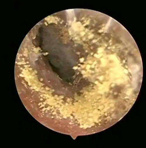 真菌性外耳道炎