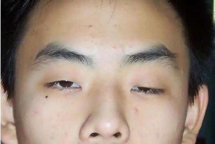 眼角膜都有移植的,为什么重度眼睑肌无力没有移植手术呢? - 知乎