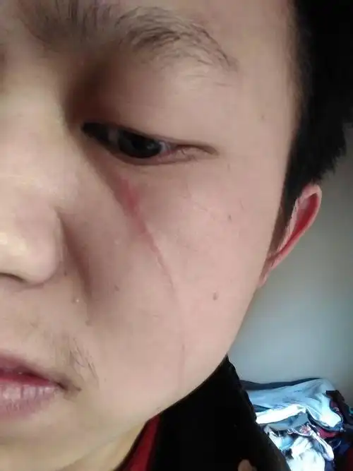 脸上被人用刀在刮伤,现在留下了疤痕,对方已在看守所待了9个月,起诉
