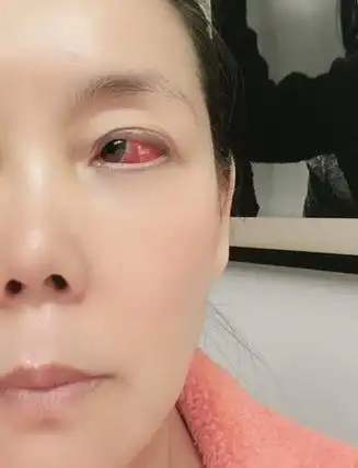 眼白处布满红红的血丝,看起来相当怵目惊心,她也傻眼直呼:怎么眼睛
