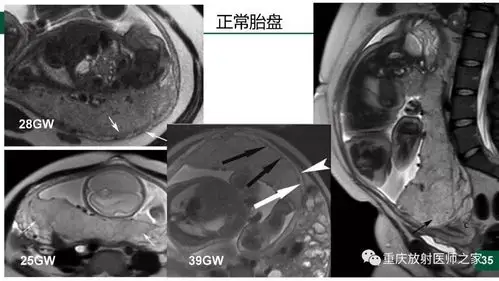 凶险性前置胎盘:影响,病理与临床