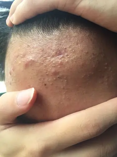 痘痘肌肤如何处理?