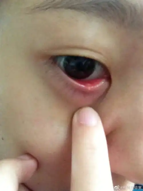 育儿##涨姿势#麦粒肿,是儿童常见的眼病之一.