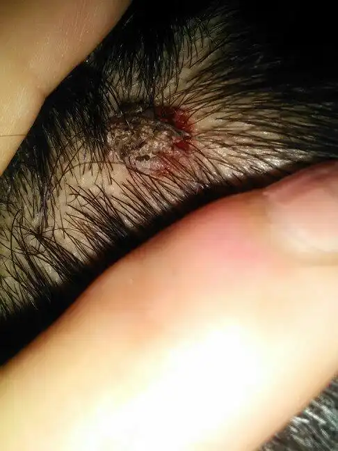 我的头上有个结痂一样的东西,有一年多了吧,一直在那
