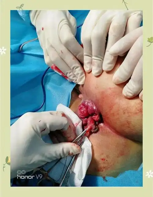 💥超严重环形混合痔手术经历分享💥