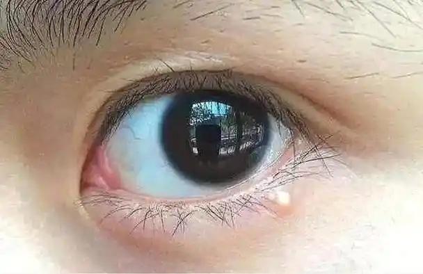 眼周长脂肪粒与护肤品无关