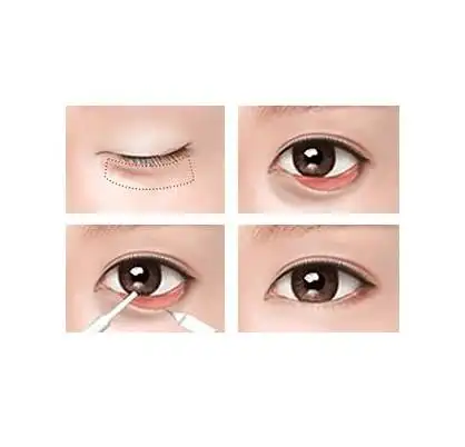 祛眼袋后为何出现下眼睑外翻,该怎么办?