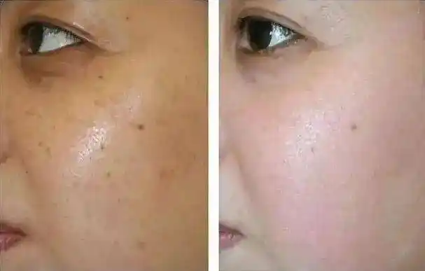 皮肤暗沉?你需要的是穴位埋线调理身体!_肤色_肌肤_智象