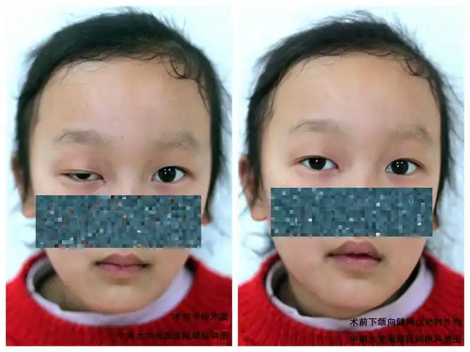 一种特殊类型的上睑下垂——marcus gunn综合征 - 好大夫在线