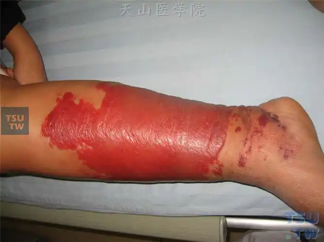 丹毒(erysipelas)症状表现 - 皮肤病学 - 天山医学院