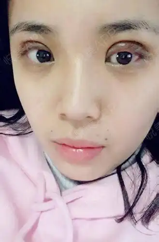 全切双眼皮术后7天_开眼角术后7天_双眼皮术后7天_眼部整形术后7天_让