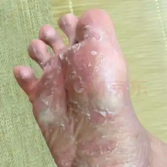 脚气喷剂脚臭喷雾除脚痒克星脱皮神器去烂l脚丫汗脚根部脚l藓鲜脚汗