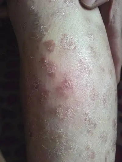 头发银屑病图片及症状图片_银屑病求医网