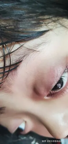 孩子眼皮上长肉粒有什么办法消除