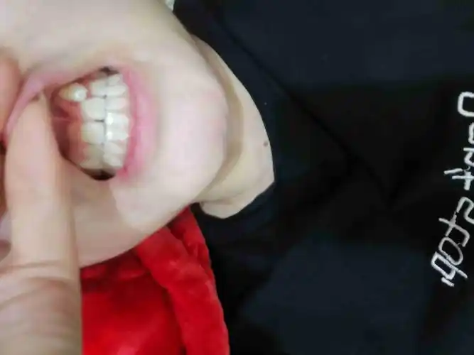 牙齿长到上面了怎么办,还能矫正吗?21岁了