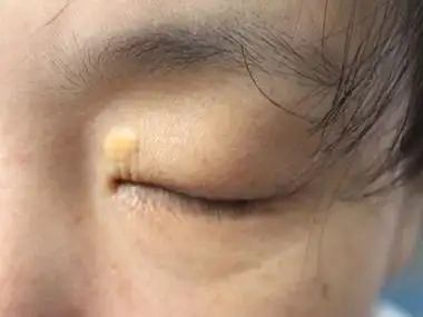 结节性黄瘤内眼角长了个小黄疙瘩图