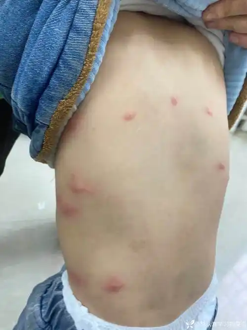 丁香园论坛>皮肤性病>帖子详情>