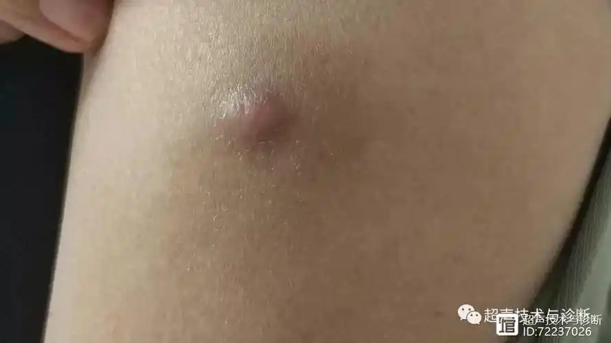 浅表超声钙化上皮瘤的超声诊断