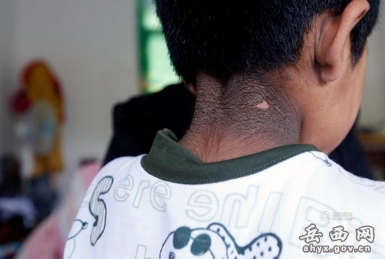 6岁男童患怪病体重30斤全身长满黑毛图