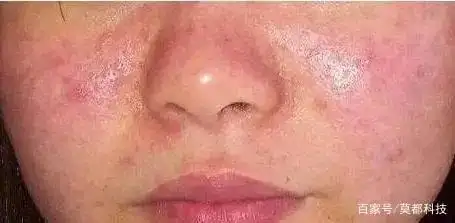 皮肤敏感角质层薄如何修复?学会这4招,舒缓敏感肌很有帮助!