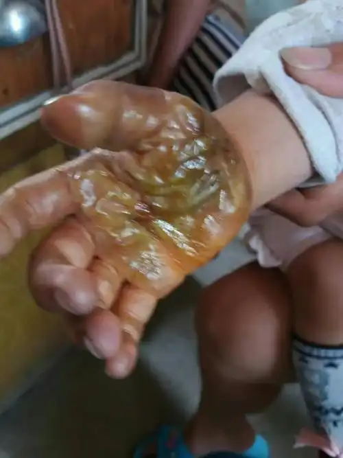 电烧伤源于电源插座.