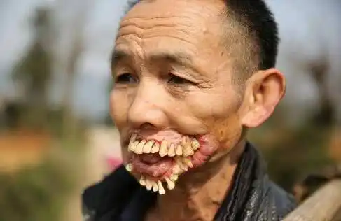 中老年牙齿越来越长,咋回事?