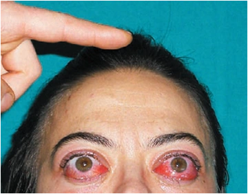 双眼球突出,眼睑退缩,球结膜充血水肿,眼球运动障碍