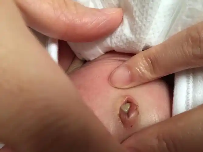 新生儿20天肚脐偶尔少量出血今天消毒完看见肚脐里有白色