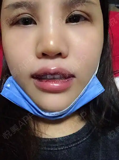 我的嘴巴比.唇形矫正_悦美整形